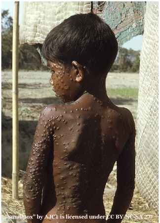 Child With Smallpox