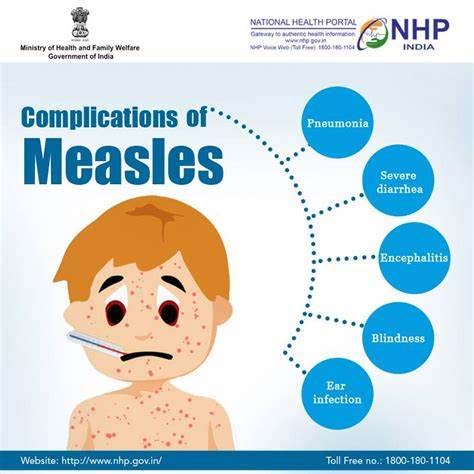 Complications of Measles