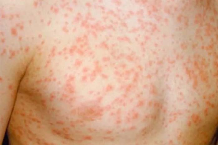 Measles Rash