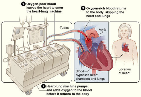 How the Heart-Lung Machine Works