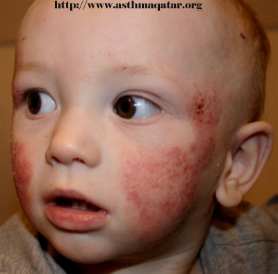 Infantile Eczema