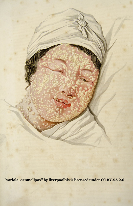 Smallpox